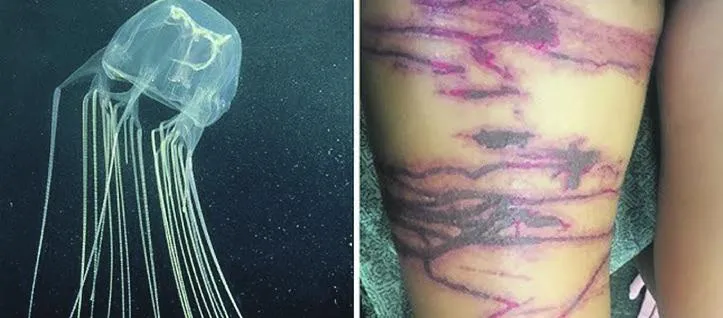 Jellyfish sting girl given urgent MAF flight